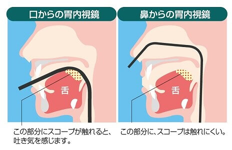 経口・経鼻の両方をお選びいただけます